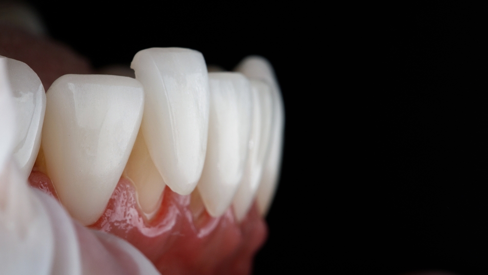 The Benefits of Choosing Dental Veneers: Porcelain vs. Composite