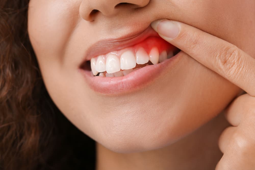 Gingivitis vs. Periodontitis: Understanding the Stages of Gum Disease